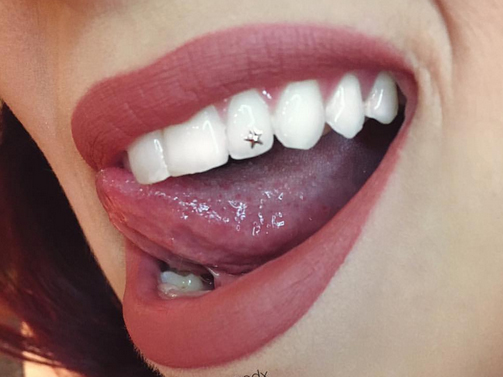 Tooth Gems Are Making A Comeback And All We Can Say Is 
